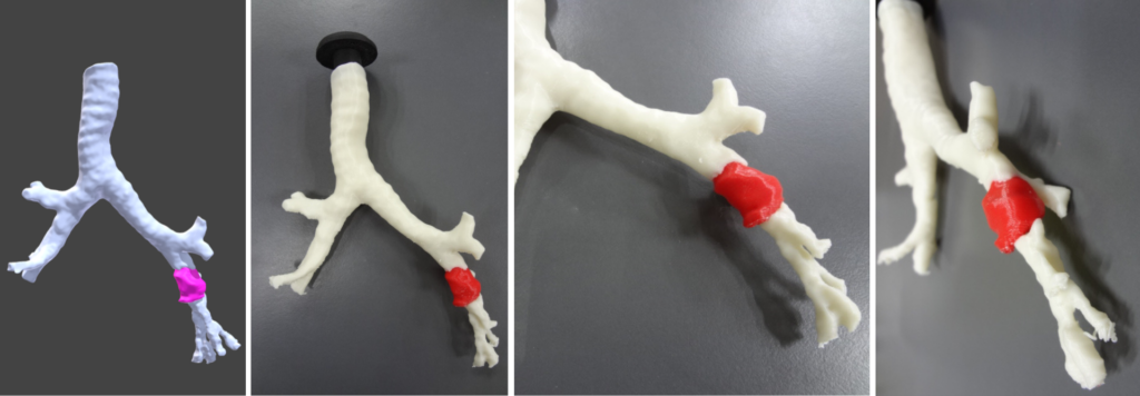 Bronchial tumor 3D biomodels