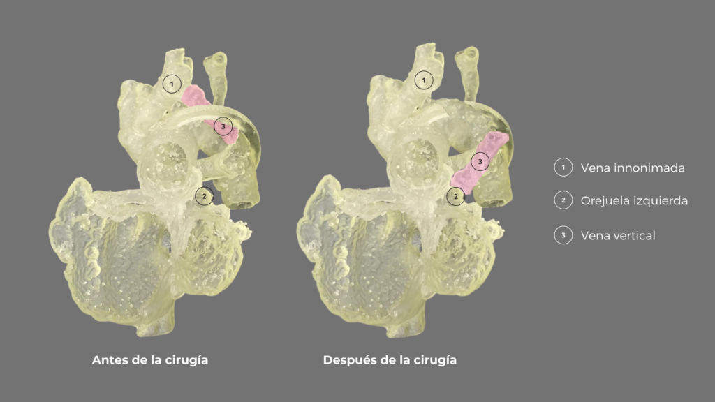 Congenital heart defect biomodel