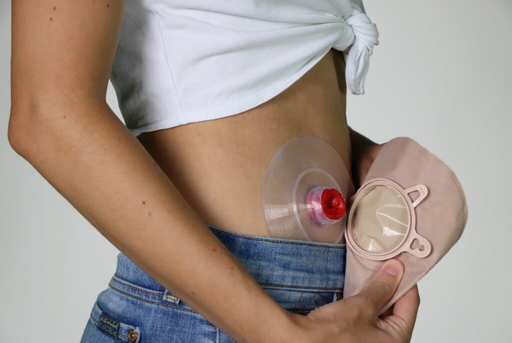 How Often Should You Change Your Ostomy Bag? – SM Health Care